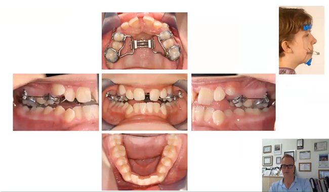 Ca lâm sàng sử dụng khí cụ nong nhanh truyền thống kết hợp Facemask 